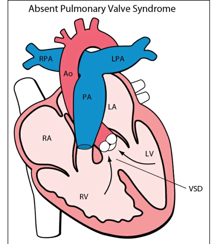 Không van động mạch phổi