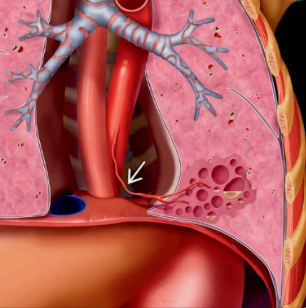 Phổi biệt trí nội thùy (Intralobar sequestration - ILS)
