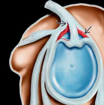 Rách sụn viền trên - SLAP (Superior labral anterior posterior tear)