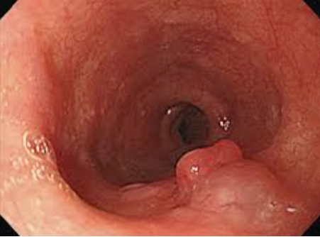 U dưới niêm thực quản (Intramural Benign Esophageal Tumors)