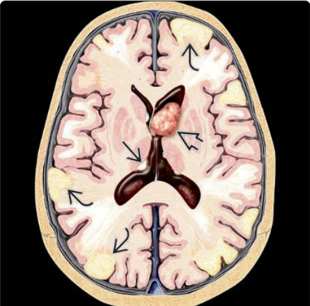 Bệnh xơ cứng củ ở thai nhi (Tuberous Sclerosis Complex - TSC)