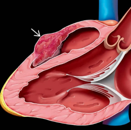Sarcoma tim (Cardiac Sarcoma)