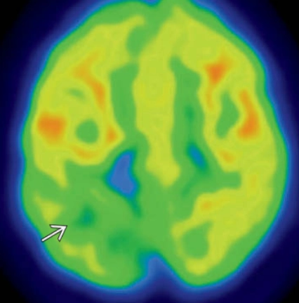 Loạn sản vỏ não khu trú (Focal Cortical Dysplasias - FCD)