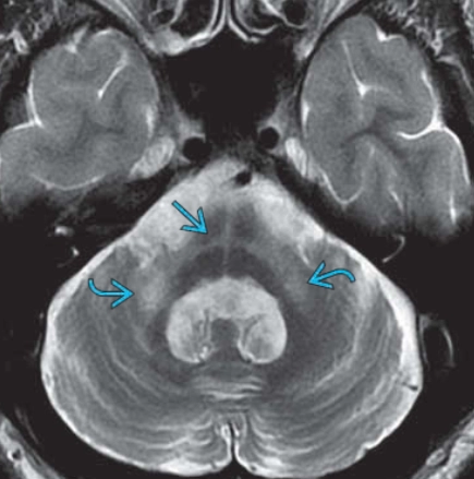 Teo đa hệ thống (Multiple system atrophy - MSA)