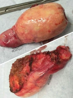 Túi mật sứ (Porcelain gallbladder)