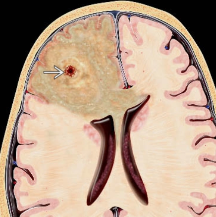 U sao bào thoái sản (Anaplastic Astrocytoma- AA)