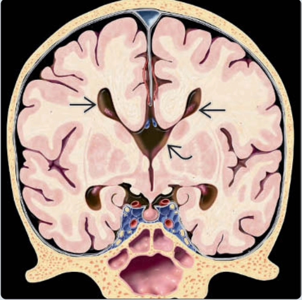 Bất sản một phần thể chai và thiểu sản thể chai (Partial agenesis &amp; hypoplasia of the corpus callosum)