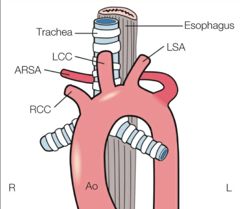 Động mạch dưới đòn phải lạc chỗ 