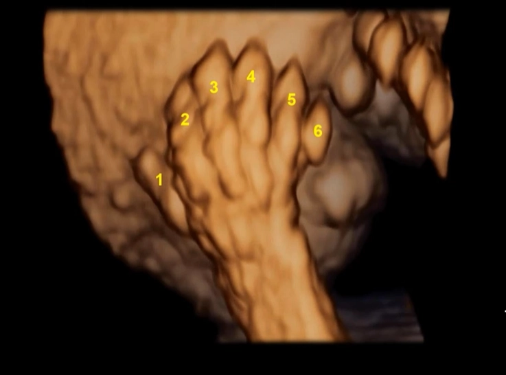 Tật đa ngón thai (Polydactyly)