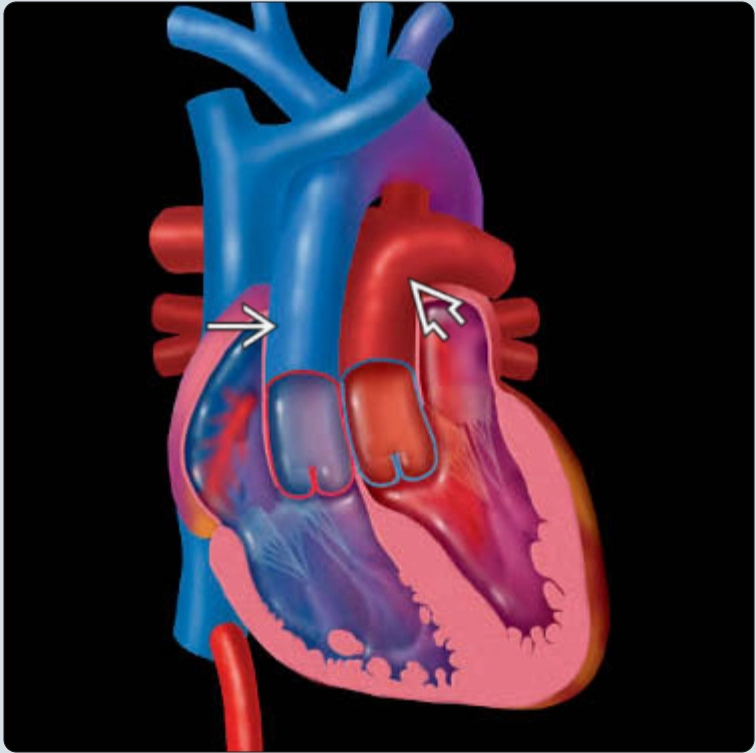 Hoán vị đại động mạch