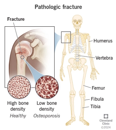 Gãy xương bệnh lý (Pathological fracture)