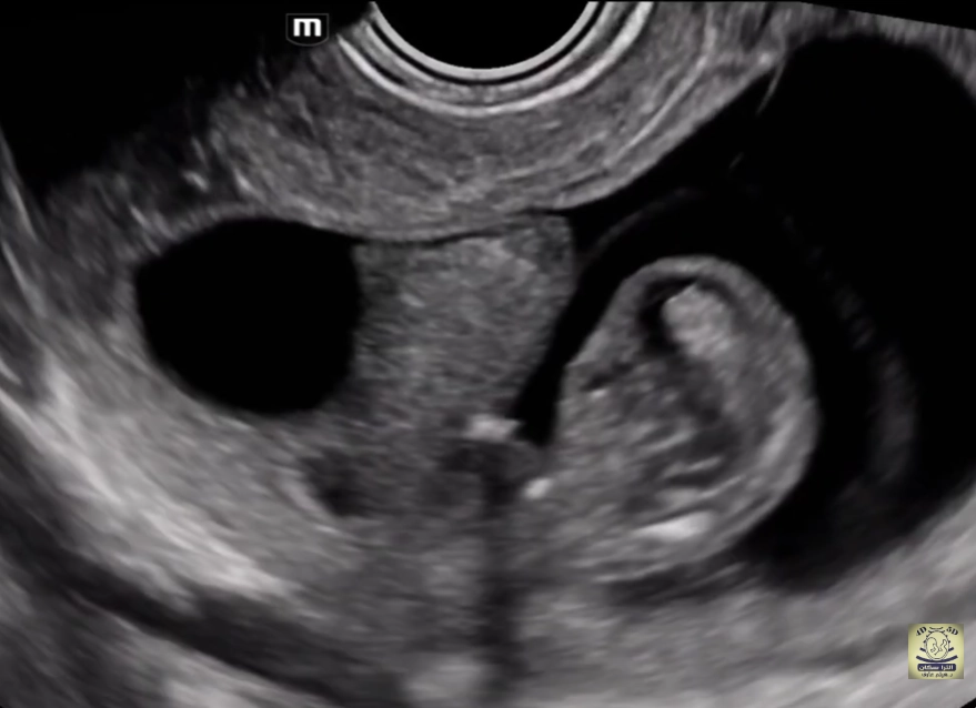 Bệnh giảm phosphatase kiềm ở thai nhi (Hypophosphatasia - HPP)