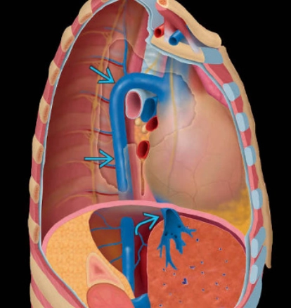 Tĩnh mạch đơn dẫn lưu cho tĩnh mạch chủ dưới (Azygos continuation of inferior vena cava - IVC)