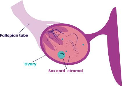 Tổng quan các khối u mô đệm / dây sinh dục của buồng trứng (Sex cord / stromal ovarian tumors)