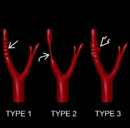 Loạn sản sợi cơ (Fibromuscular Dysplasia - FD) 