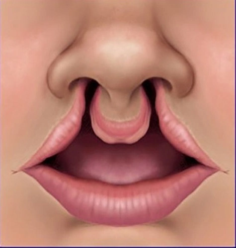 Sứt môi hở hàm ếch (Cleft lip and palate)