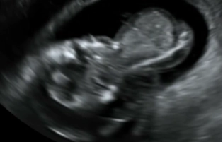 Loạn sản xương do cốt hóa không hoàn chỉnh (Atelosteogenesis)