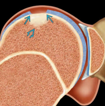 Tổn thương sụn-xương ở vai (Osteochondral Injury, Shoulder)