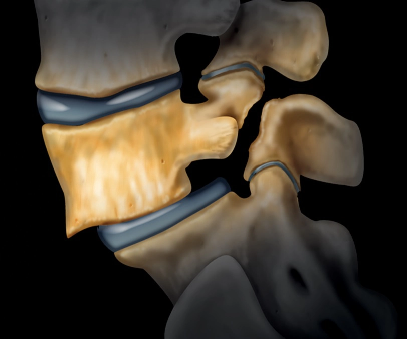 Thoái hóa cột sống (Degenerative spine)