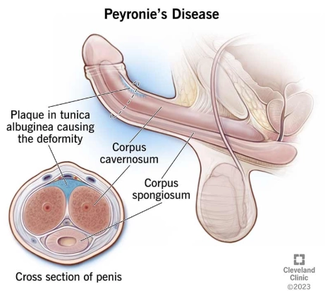 Bệnh Peyronie (xơ chai dương vật)