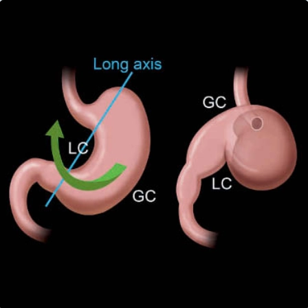 Xoắn dạ dày (Gastric Volvulus)