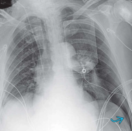 Dấu hiệu rãnh sâu (Deep Sulcus Sign) (ngực)