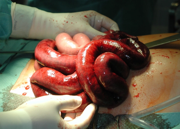 Liệt ruột cơ năng (Adynamic ileus)