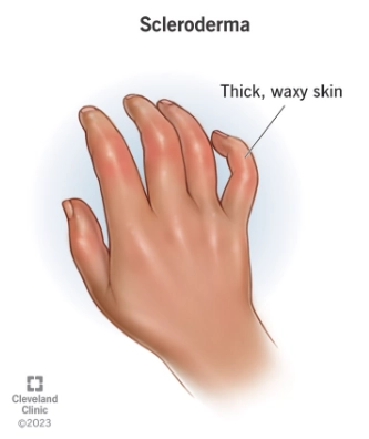 Biểu hiện cơ xương khớp của bệnh xơ cứng bì (Scleroderma)