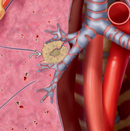 Bệnh Castleman (Castleman disease)
