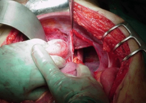 Vỡ cơ hoành do chấn thương (Traumatic Diaphragmatic Rupture)