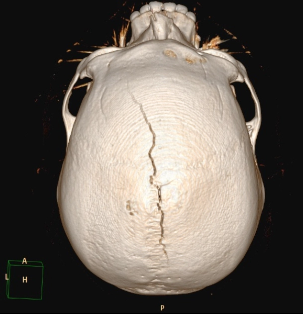 Tụ máu ngoài màng cứng nguồn gốc tĩnh mạch (Venous Extradural Hemorrhage / Venous EDH)