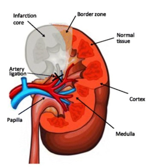 Nhồi máu thận (Renal infarction)