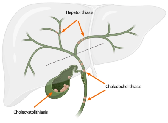Sỏi đường mật trong gan (Hepatolithiasis)