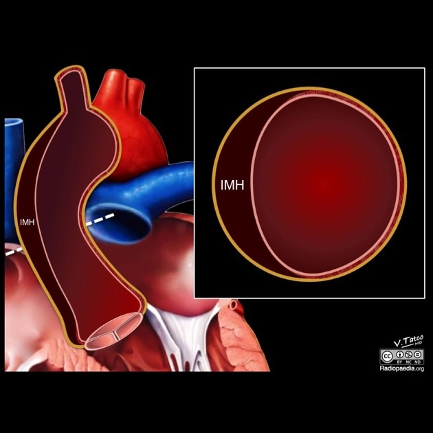 Hội chứng Động Mạch Chủ Cấp (Acute Aortic Syndrome)