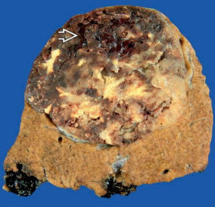 U cơ mỡ mạch gan (Hepatic Angiomyolipoma - AML)