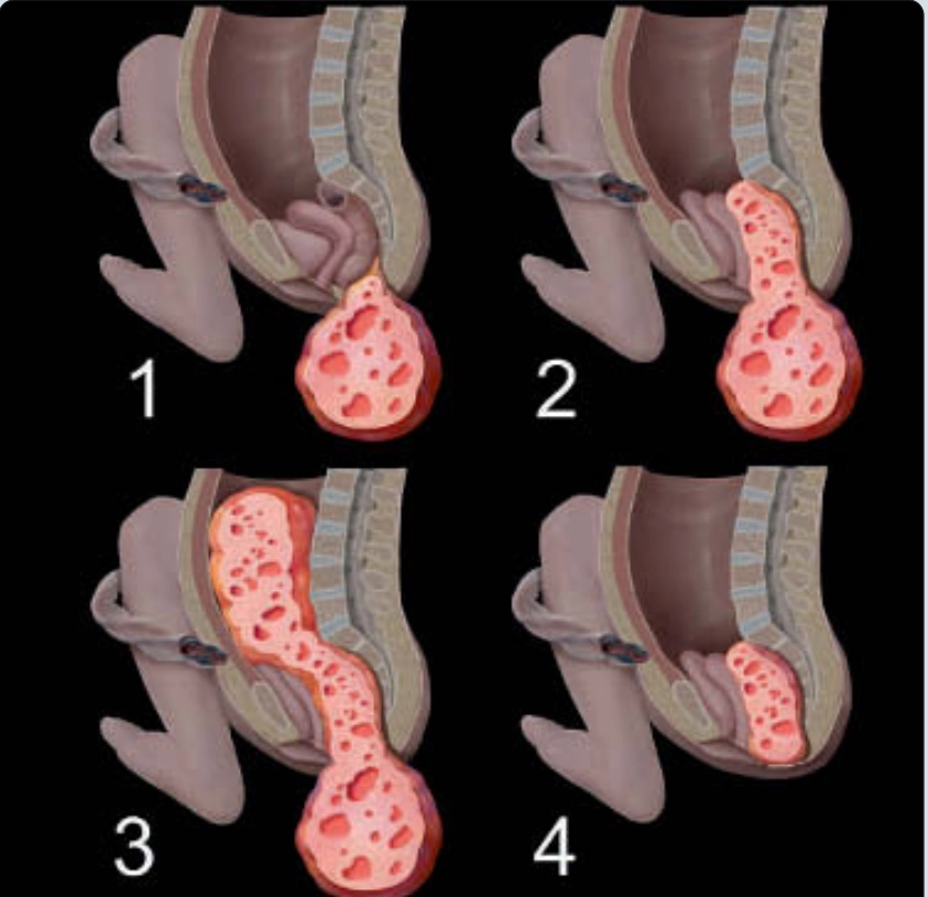 U quái vùng cùng cụt (Sacrococcygeal Teratoma)