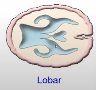 Não trước không phân chia thể phân thùy (Lobar holoprosencephaly)