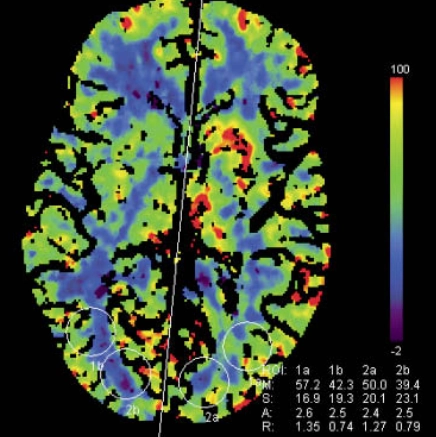 Hội chứng tăng tưới máu não (Cerebral hyperperfusion syndrome - CHS)
