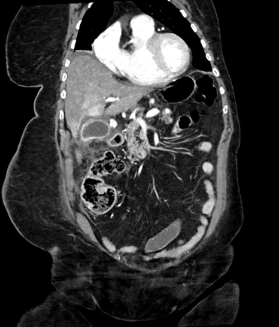 Giả phình động mạch túi mật (Cystic Artery Pseudoaneurysm - CAP)