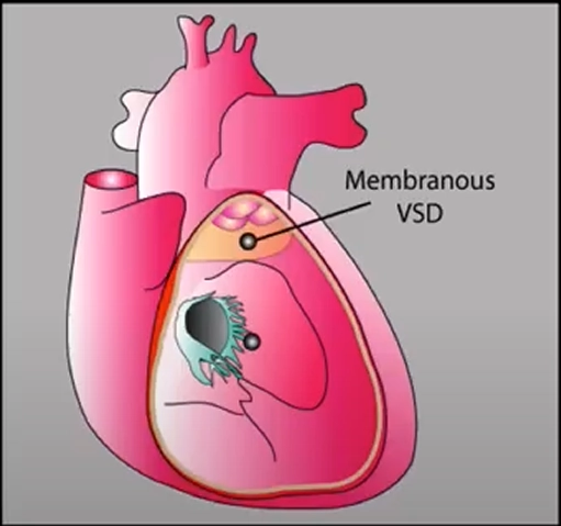 Thông liên thất phần màng (Perimembranous VSD)