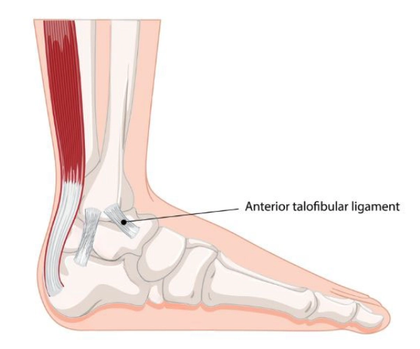 Tổn thương dây chằng sên-mác trước (Anterior Talofibular Ligament - ATFL injury)