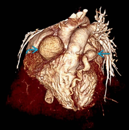 Phình động mạch vành (Coronary artery aneurysm)