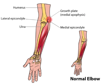 Tổn thương khuỷu tay do stress vẹo ngoài/Khuỷu tay của cầu thủ ném bóng nhí (Valgus Stress Mechanism/Little Leaguer's Elbow)
