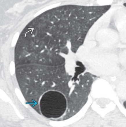 Kén khí trong nhu mô phổi (Pneumatocele) 