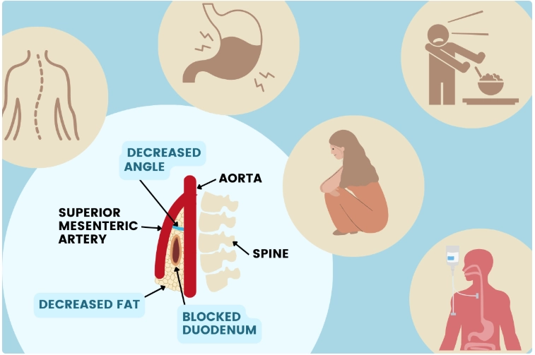 Hội chứng động mạch mạc treo tràng trên (Superior mesenteric artery syndrome - SMA)