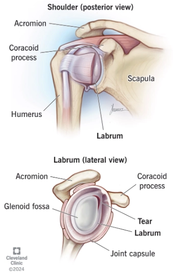 Rách sụn viền ổ chảo phía sau (Reverse Bankart lesion)
