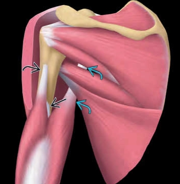 Rách phần gần (phía vai) của cơ tam đầu cánh tay (Proximal Triceps Injury) 