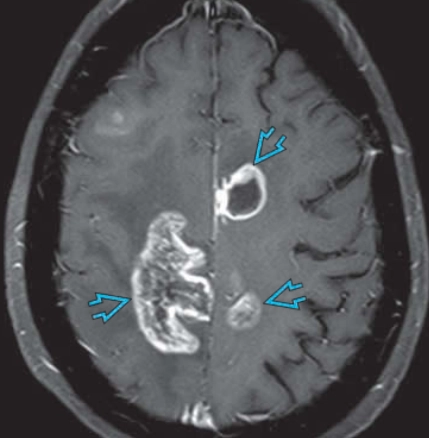 Giả tiến triển khối u sau điều trị (Tumor pseudoprogression)