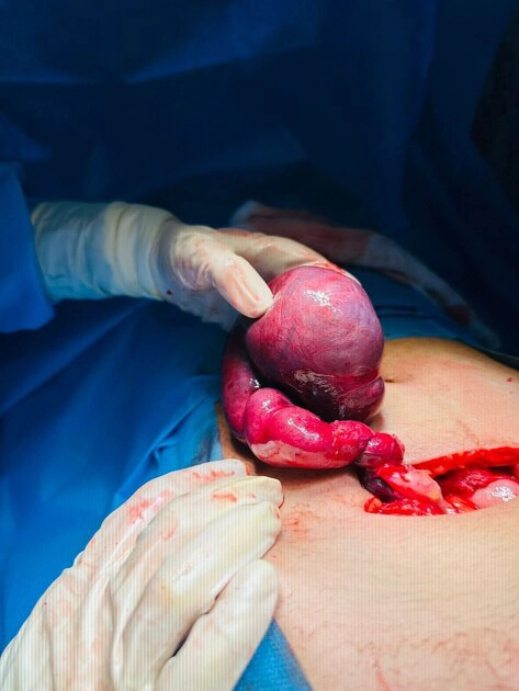 Xoắn vòi trứng (Fallopian tube torsion)