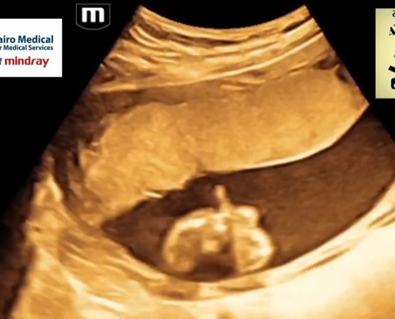 Tật khuyết ngón (Ectrodactyly), tật chẻ bàn tay / bàn chân (Split Hand / Foot Malformation - SHFM) hay tật càng tôm